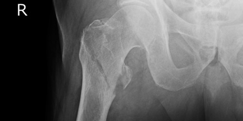 Osteoporosis And Broken Bones: What Can You Expect From Hip Fractures?